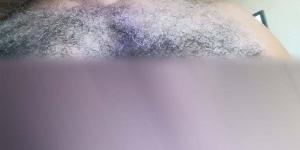محامٍ يحرر محضرًا ضد طبيب جلدية شهير بالغربية بتهمة التسبب في حروق بالصدر
