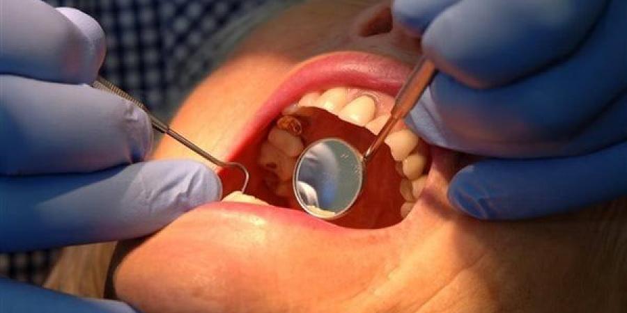 أطباء يحذرون من تبييض الأسنان بسبب تهديدها لصحة الفم.. تعرف على التفاصيل